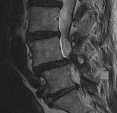 L45 Spondylolithesis MRI